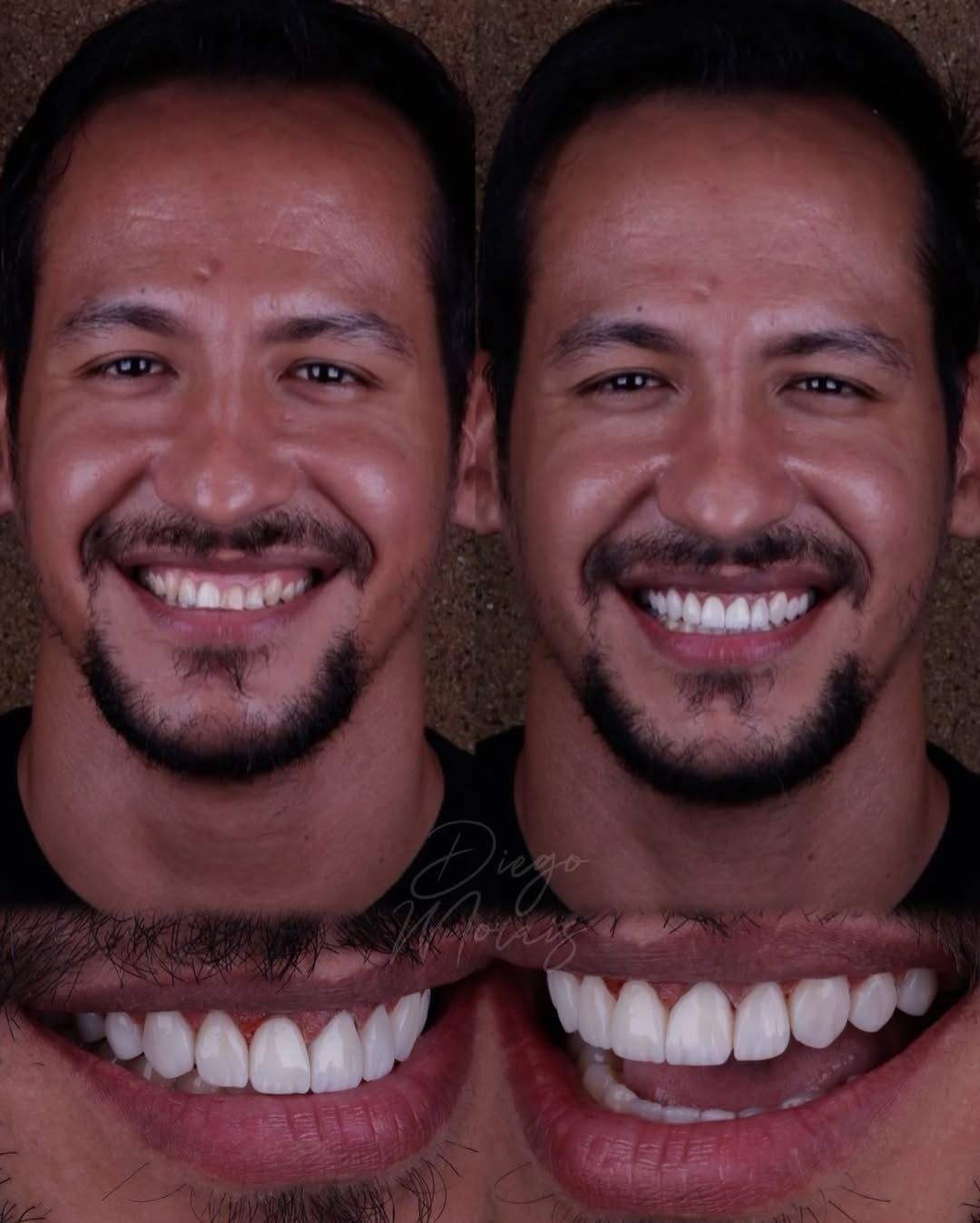 Caso 1: sorriso do paciente antes e depois do tratamento