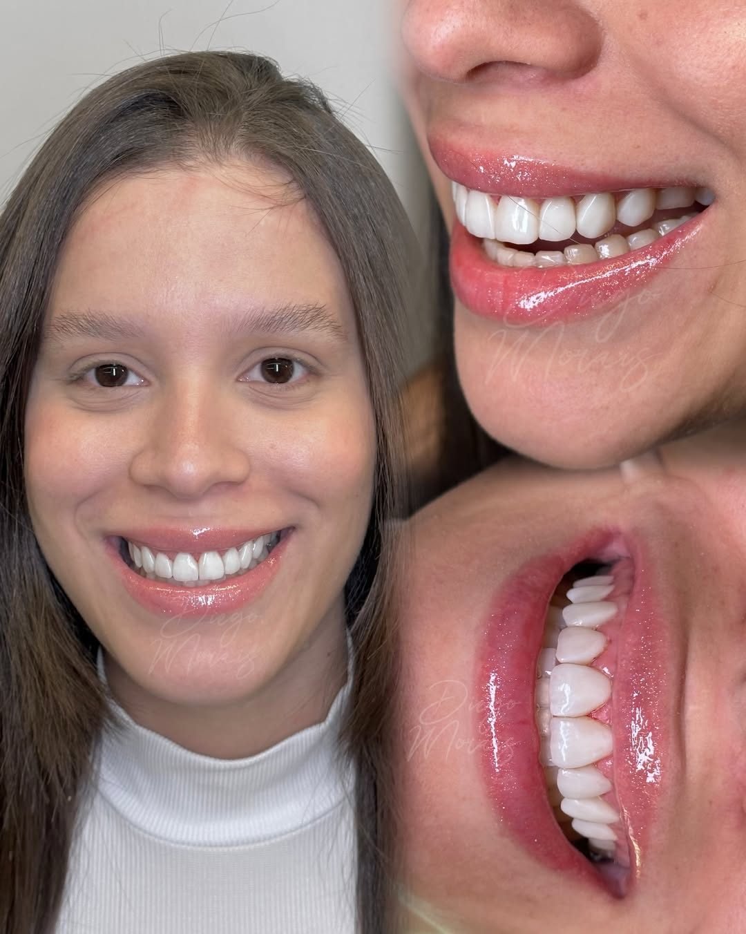 Caso 2: sorriso da paciente de frente e de perfil após o tratamento