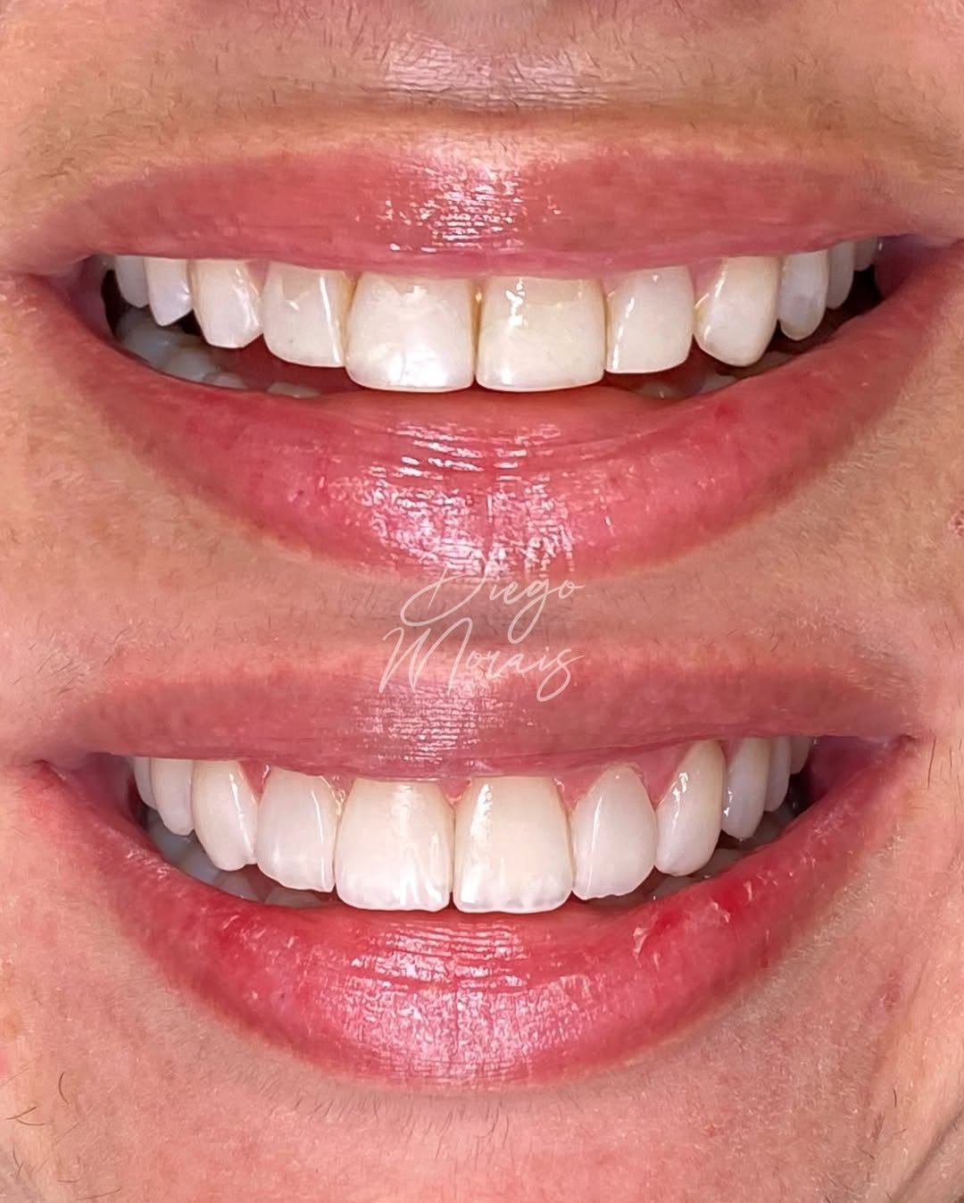 Caso 3: dentes antes (acima) e depois (abaixo)
