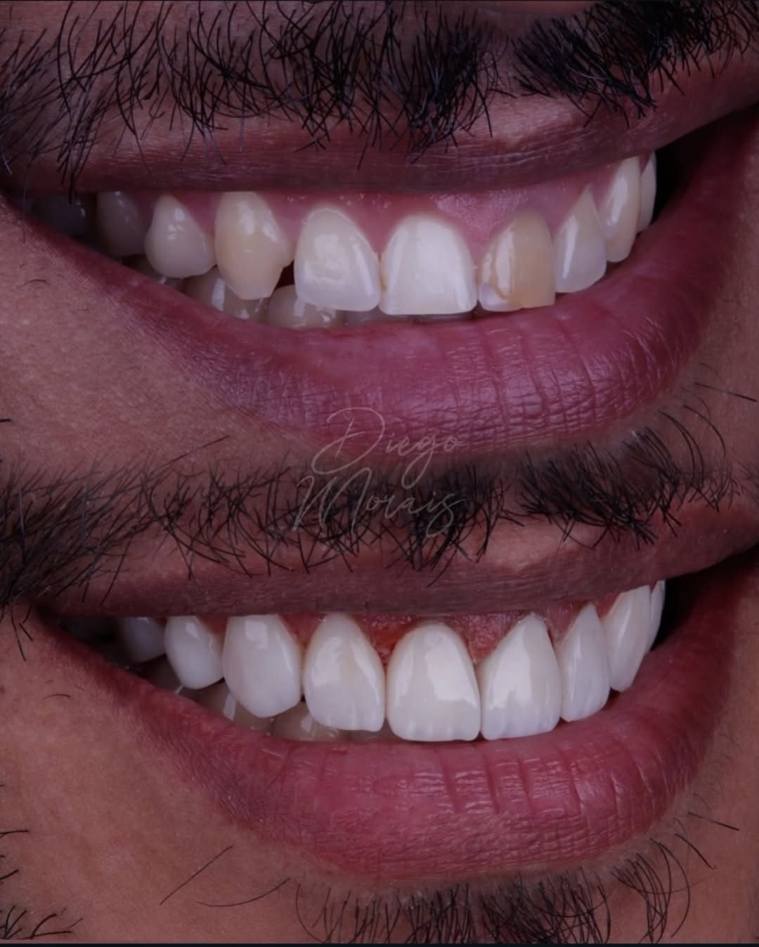 Caso 5: dentes antes (acima) e depois (abaixo)