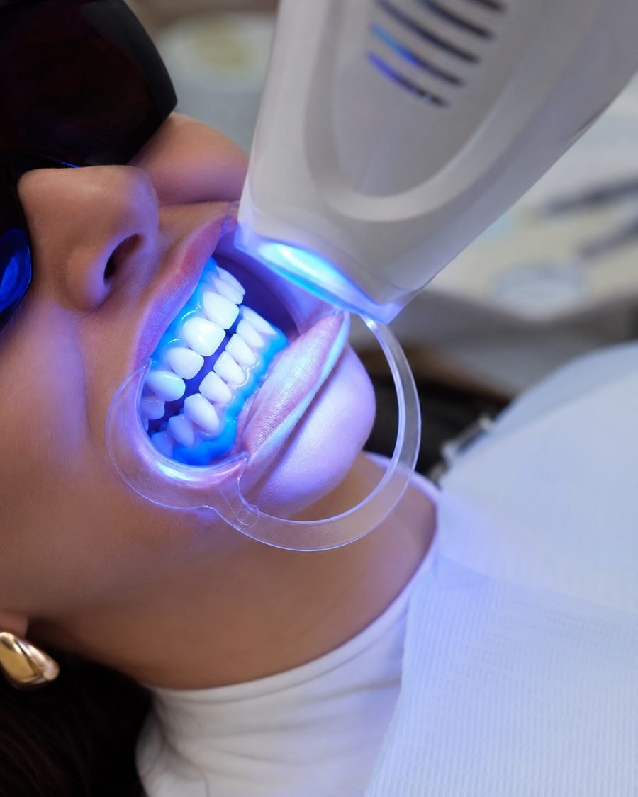 Clareamento de consultório com luz azul